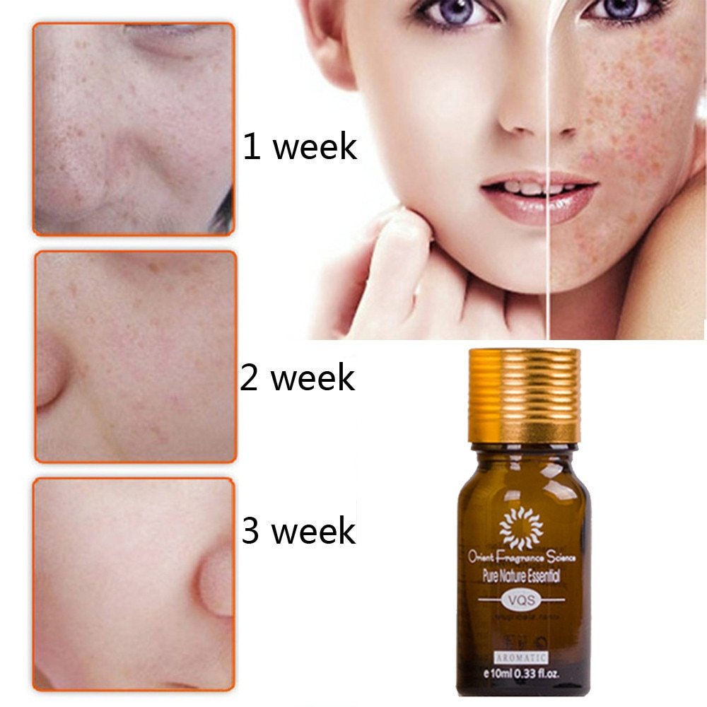 Dredge Meridian Skin Care , Natural Pure Removal Acne-Stretch Marks-Scar Removal Essence oil